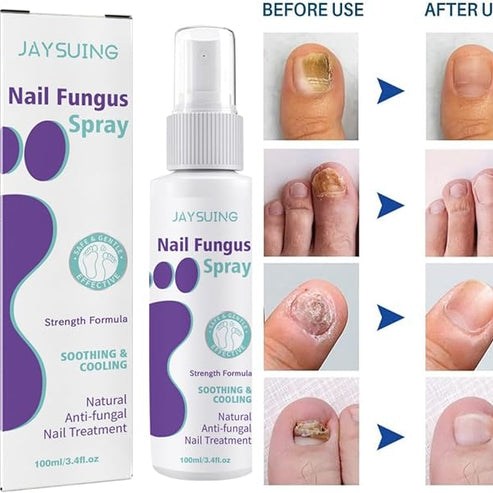 Nail Fungus Spray